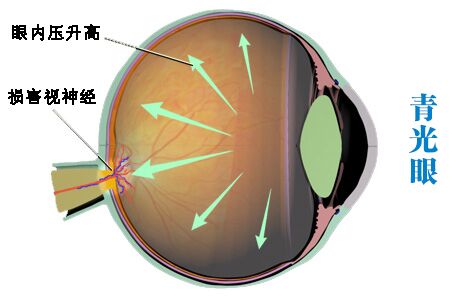 患青光眼為什么會失明?
