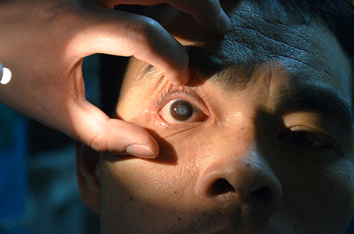 角膜移植手術的成功率有多高?